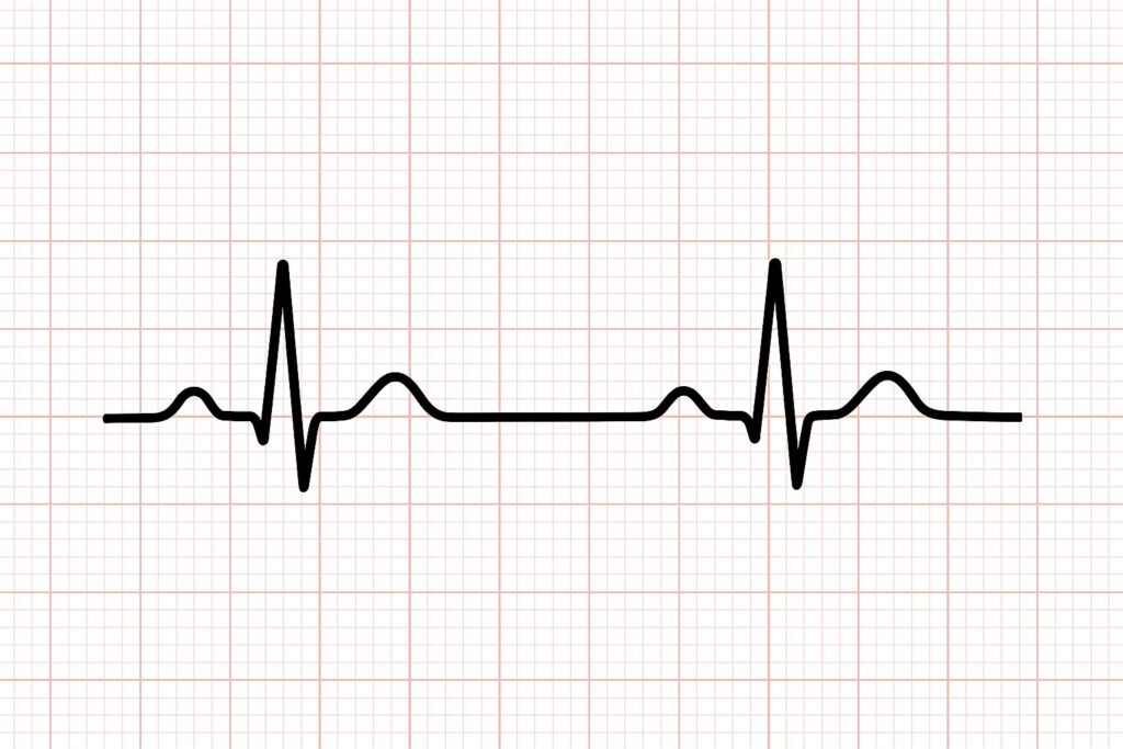 洞調律（SR）の図