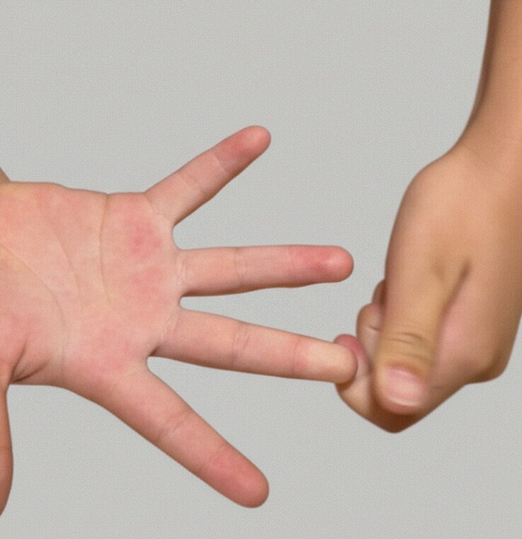 毛細血管再充満時間