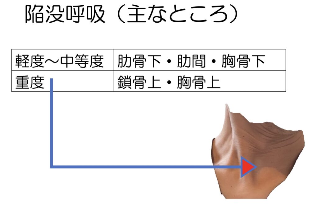陥没呼吸の説明